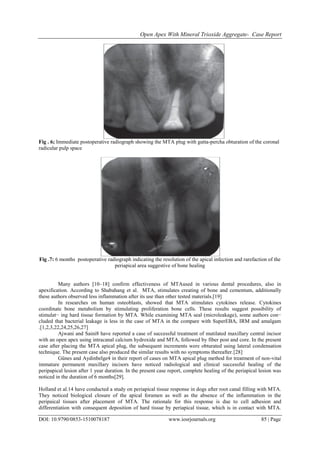 Open Apex with Mineral Trioxide Aggregate- Case Report | PDF