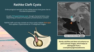 Rarely calcifies and does not enhance on
post contrast images, which helps to
distinguish from a
craniopharyngioma/adenoma
Rathke Cleft Cysts
Embryological remnant of the rathke pouch that gives rise to
the adenohypophysis.
Usually T2 hyperintense cyst, though characteristics vary
depending on level of intracystic proteinaceous content.
Rathke cleft cyst may contain an intra-cystic nodule (Dot sign)
that appears hypointense on T2-weighted images.
Case: Frank Gillard rID: 16835
 