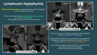 Lymphocytic Hypophysitis
Most common in women, especially during late pregnancy
or the postpartum period.
Often shows symmetric enlargement of the pituitary
gland and infundibulum
Homogeneous post contrast enhancement
Characteristic low T2 signal intensity in the parasellar
regions: Parasellar T2 Dark Sign
Unlike pituitary adenomas, lymphocytic hypophysitis
frequently involves the posterior pituitary. This can
result in the loss of the normal bright spot
Associations: autoimmune conditions- autoimmune
thyroiditis, pernicious anaemia
monoclonal antibody ipilimumab
Case: Dalia Ibrahim rID: 100185
Case: Dalia Ibrahim rID: 100185
 