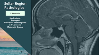 Sellar Region
Pathologies
2. Parasellar
Meningioma
Aneurysm
Cavernous haemangioma
Schwannoma
Metastatic disease
 