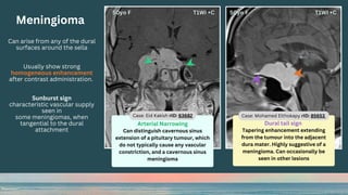 Dural tail sign
Tapering enhancement extending
from the tumour into the adjacent
dura mater. Highly suggestive of a
meningioma. Can occasionally be
seen in other lesions
Meningioma
Can arise from any of the dural
surfaces around the sella
Usually show strong
homogeneous enhancement
after contrast administration.
Sunburst sign
characteristic vascular supply
seen in
some meningiomas, when
tangential to the dural
attachment
Arterial Narrowing
Can distinguish cavernous sinus
extension of a pituitary tumour, which
do not typically cause any vascular
constriction, and a cavernous sinus
meningioma
Case: Eid Kakish rID: 63682 Case: Mohamed Elthokapy rID: 85653
 