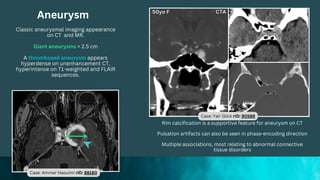 Aneurysm
Classic aneurysmal imaging appearance
on CT and MR.
Giant aneurysms > 2.5 cm
A thrombosed aneurysm appears
hyperdense on unenhancement CT,
hyperintense on T1-weighted and FLAIR
sequences.
Rim calcification is a supportive feature for aneurysm on CT
Pulsation artifacts can also be seen in phase-encoding direction
Multiple associations, most relating to abnormal connective
tissue disorders
Case: Yaïr Glick rID: 90589
Case: Ammar Haouimi rID: 88180
 