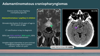 Distinct entity from Papillary
craniopharyngiomas
Adamantinomatous > papillary in children
Bimodal distribution (5-15 years of age to
50-70 years of age)
CT calcification is key to diagnosis
90% rule: 90% calcified, 90% cystic, 90%
peripheral enhancement
Variable signal intensities on pre-contrast
T1-weighted images due to protein
content "motor oil cysts"
Adamantinomatous craniopharyngiomas
Case: Henry Knipe rID: 42681
 