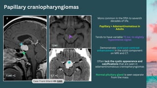 Papillary craniopharyngiomas
More common in the fifth to seventh
decades of life.
Papillary > Adamantino﻿
matous in
Adults
Tends to have variable T1 iso- to slightly
hypointense signal
Demonstrate vivid post contrast
enhancement in the solid component
on MRI and CT.
Often lack the cystic appearance and
calcifications that are seen in
adamantinomatous craniopharyngiomas
Normal pituitary gland is seen separate
from the mass
Case: Frank Gillard rID: 5365
 