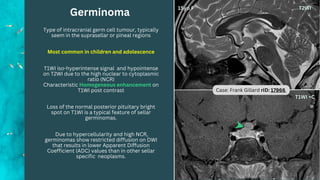 Germinoma
Case: Frank Gillard rID: 17966
Type of intracranial germ cell tumour, typically
seem in the suprasellar or pineal regions
Most common in children and adolescence
T1WI iso-hyperintense signal and hypointense
on T2WI due to the high nuclear to cytoplasmic
ratio (NCR)
Characteristic Homogeneous enhancement on
T1WI post contrast
Loss of the normal posterior pituitary bright
spot on T1WI is a typical feature of sellar
germinomas.
Due to hypercellularity and high NCR,
germinomas show restricted diffusion on DWI
that results in lower Apparent Diffusion
Coefficient (ADC) values than in other sellar
specific neoplasms.
 