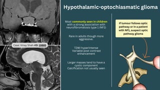 Hypothalamic-optochiasmatic glioma
If tumour follows optic
pathway or in a patient
with NF1, suspect optic
pathway glioma
Most commonly seen in children
with a strong association with
neurofibromatosis type 1 (NF1)
Rare in adults though more
aggressive.
T2WI hyperintense
Variable post contrast
enhancement
Larger masses tend to have a
cystic component
Calcification not usually seen
Case: Vinay Shah rID: 19885
 
