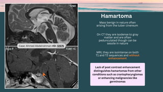 Hamartoma
Mass benign in nature often
arising from the tuber cinereum
On CT they are isodense to gray
matter and are often
pedunculated though can be
sessile in nature
MRI; they are isointense on both
T1 and T2 sequences and without
enhancement
Case: Ahmed Abdelrahman rID: 72575
Lack of post contrast enhancement
distinguishes hamartomas from other
conditions such as craniopharyngiomas
or enhancing malignancies like
germinomas
 