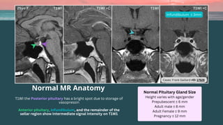Normal MR Anatomy
T1WI the Posterior pituitary has a bright spot due to storage of
vasopressin
Anterior pituitary, Infundibulum, and the remainder of the
sellar region show intermediate signal intensity on T1W1
Normal Pituitary Gland Size
Height varies with age/gender
Prepubescent ≤ 6 mm
Adult male ≤ 8 mm
Adult Female ≤ 9 mm
Pregnancy ≤ 12 mm
Infundibulum ≤ 3mm
Cases: Frank Gaillard rID: 17529
 