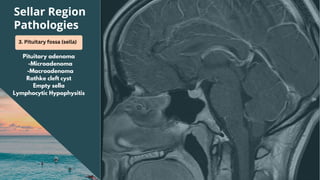 Sellar Region
Pathologies
3. Pituitary fossa (sella)
Pituitary adenoma
-Microadenoma
-Macroadenoma
Rathke cleft cyst
Empty sella
Lymphocytic Hypophysitis
 