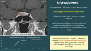 Best visualised on post contrast T1-weighted
imaging. Round focus of hypoenhancement in
right pituitary. Though dynamic contrast
enhanced MRI can improve sensitivity and
specificity.
Anterior pituitary solid mass, <10mm within the sella
Incidence greater in females than males
Prolactinoma is the most common functional
adenoma
Majority vascularised by the hypophyseal portal
system which demonstrates classic delayed
interstitial contrast diffusion compared to normal
tissue
Microadenoma
Anterior Pituitary MRI Signal Microandenoma MRI Signal
Time (Gd) 20 30 60 90 120 150
50
40
30
20
10
0
Adapted from Denis Gardeur, 2016
Case: Frank Gaillard rID: 16787
 