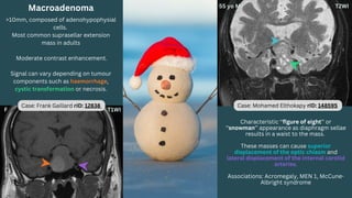Case: Mohamed Elthokapy rID: 148595
Macroadenoma
>10mm, composed of adenohypophysial
cells.
Most common suprasellar extension
mass in adults
Moderate contrast enhancement.
Signal can vary depending on tumour
components such as haemorrhage,
cystic transformation or necrosis.
Characteristic ‘‘figure of eight’’ or
‘‘snowman’’ appearance as diaphragm sellae
results in a waist to the mass.
These masses can cause superior
displacement of the optic chiasm and
lateral displacement of the internal carotid
arteries.
Associations: Acromegaly, MEN 1, McCune-
Albright syndrome
Case: Frank Gaillard rID: 12838
 