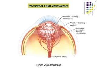 Pphpv Eye The presentation describes Persistent Fetal Vasculature (PFV), an ...