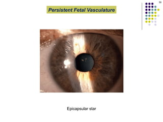 Pphpv Eye The presentation describes Persistent Fetal Vasculature (PFV), an ...
