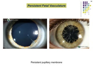 Pphpv Eye The presentation describes Persistent Fetal Vasculature (PFV), an ...