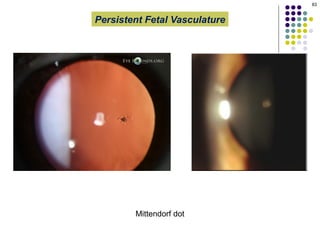 Pphpv Eye The presentation describes Persistent Fetal Vasculature (PFV), an ...