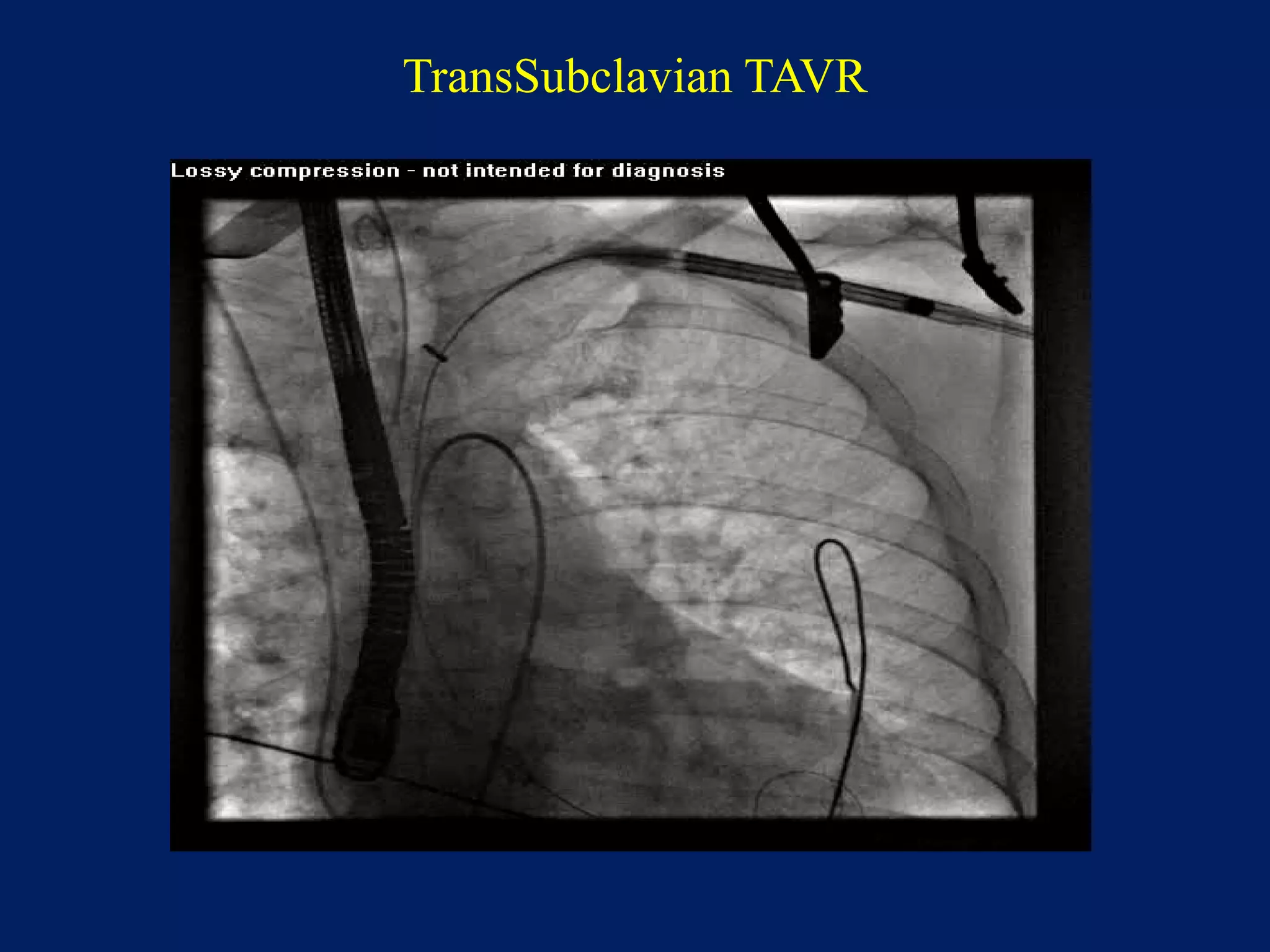 TransSubclavian TAVR
 