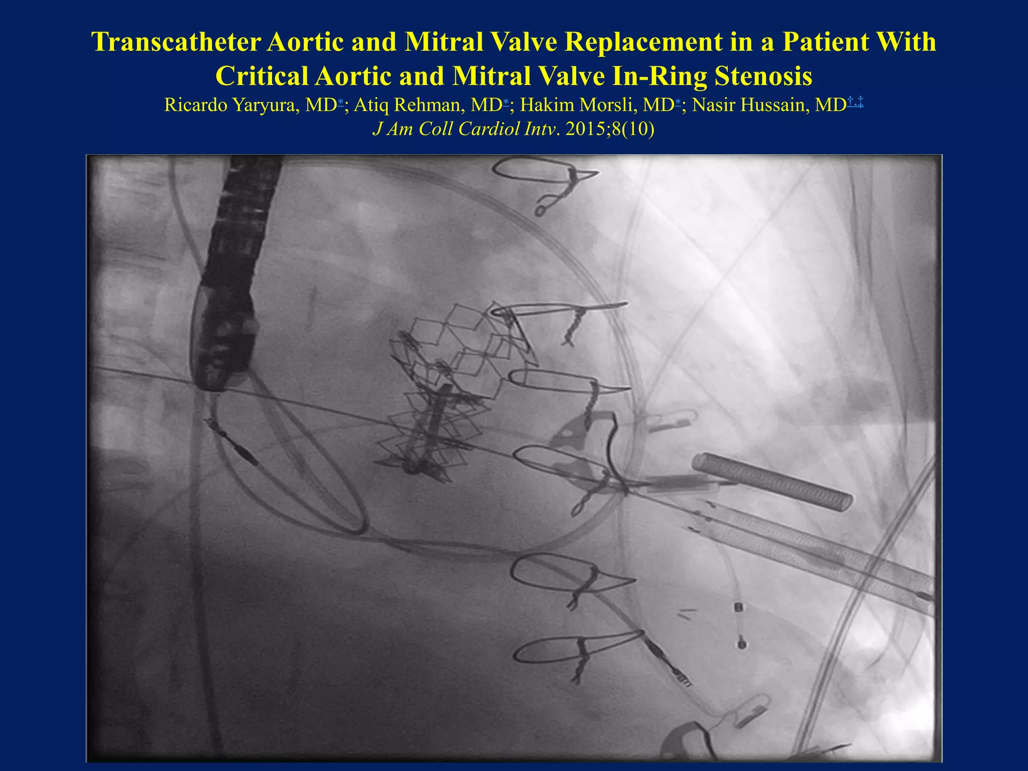 Transcatheter Aortic and Mitral Valve Replacement in a Patient With
Critical Aortic and Mitral Valve In-Ring Stenosis
Ricardo Yaryura, MD∗; Atiq Rehman, MD∗; Hakim Morsli, MD∗; Nasir Hussain, MD†,‡
J Am Coll Cardiol Intv. 2015;8(10)
 