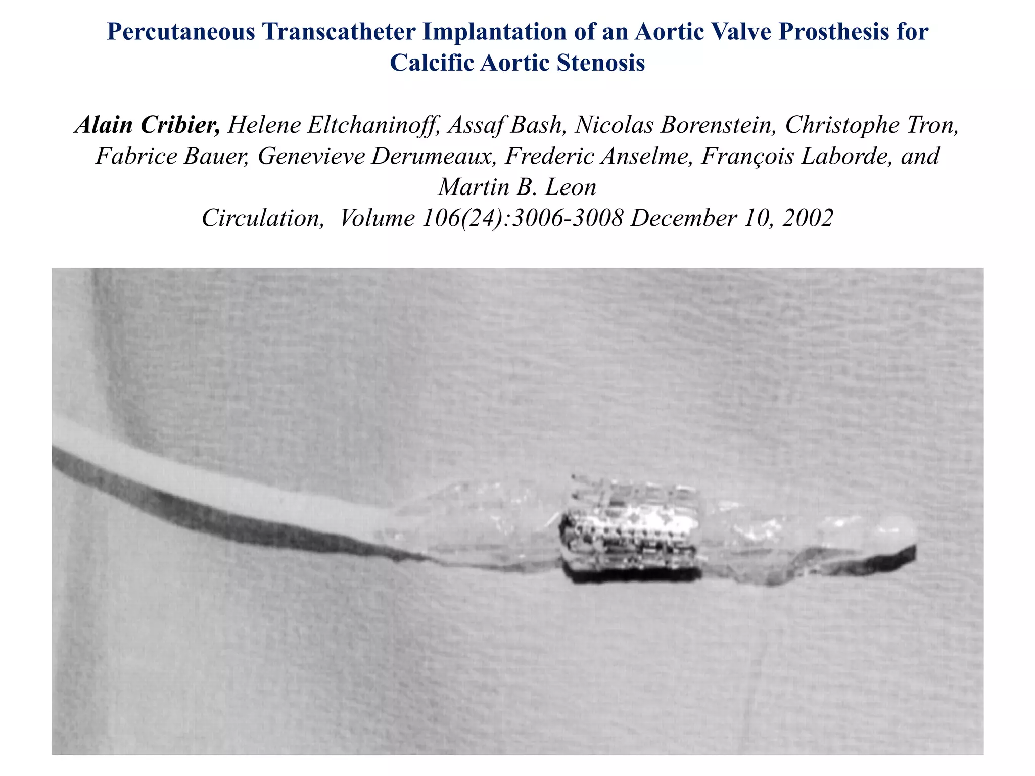 Percutaneous Transcatheter Implantation of an Aortic Valve Prosthesis for
Calcific Aortic Stenosis
Alain Cribier, Helene Eltchaninoff, Assaf Bash, Nicolas Borenstein, Christophe Tron,
Fabrice Bauer, Genevieve Derumeaux, Frederic Anselme, François Laborde, and
Martin B. Leon
Circulation, Volume 106(24):3006-3008 December 10, 2002
 