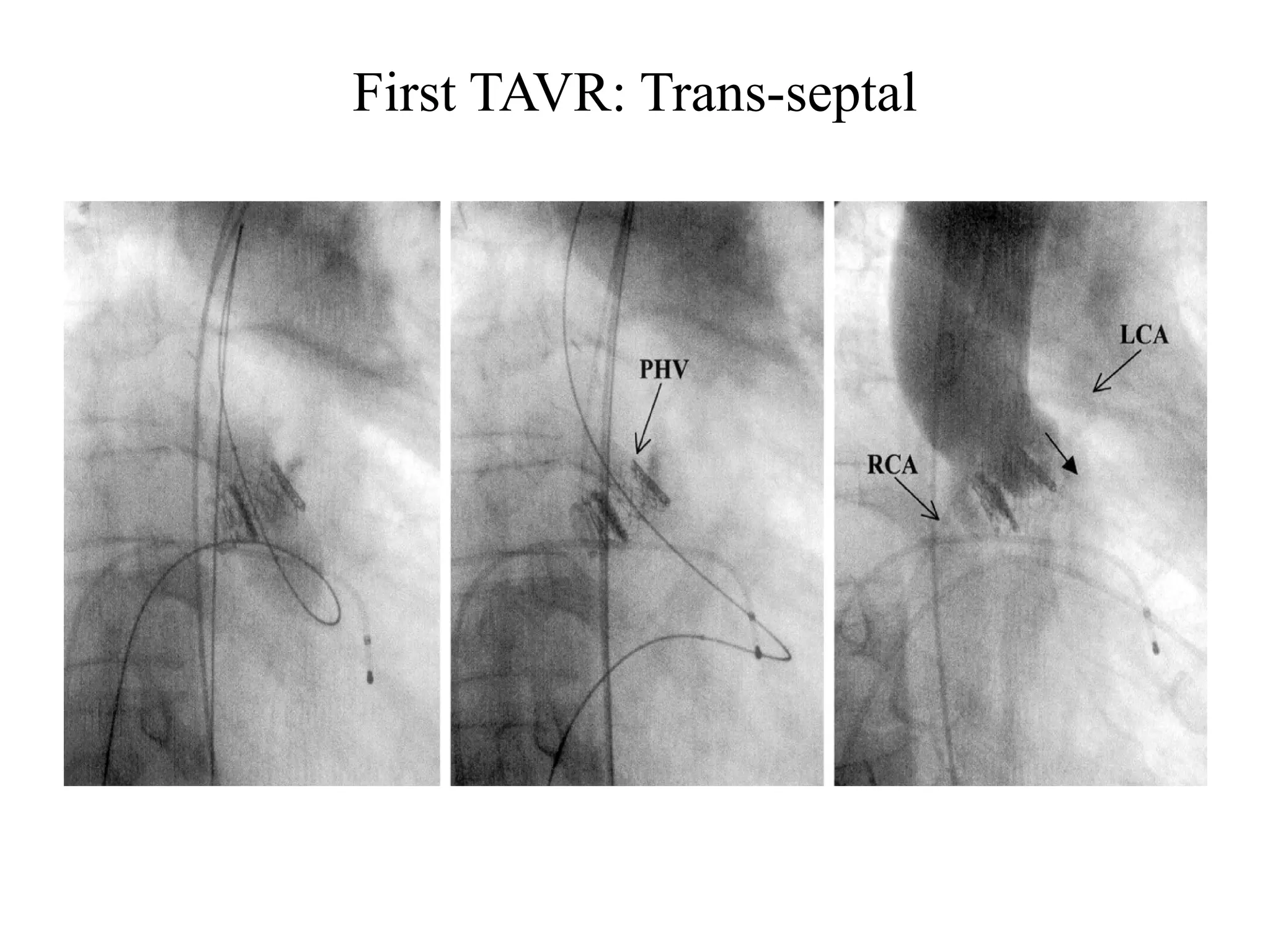 First TAVR: Trans-septal
 
