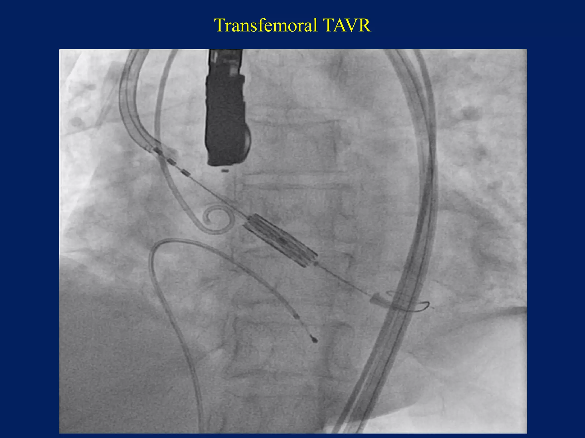 Transfemoral TAVR
 