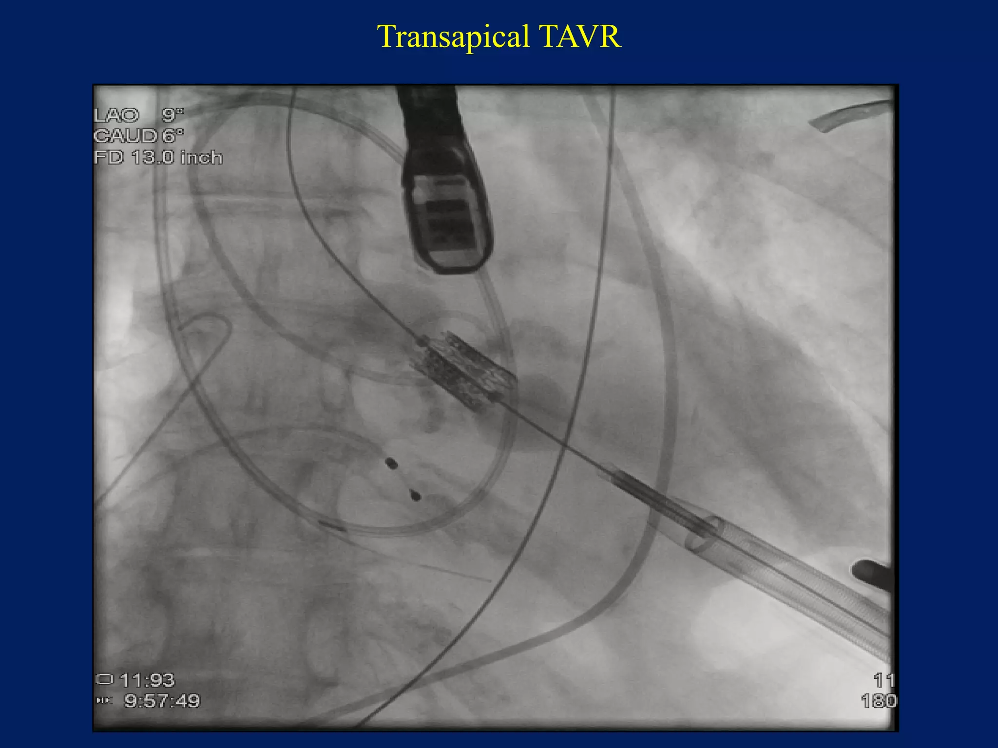 Transapical TAVR
 