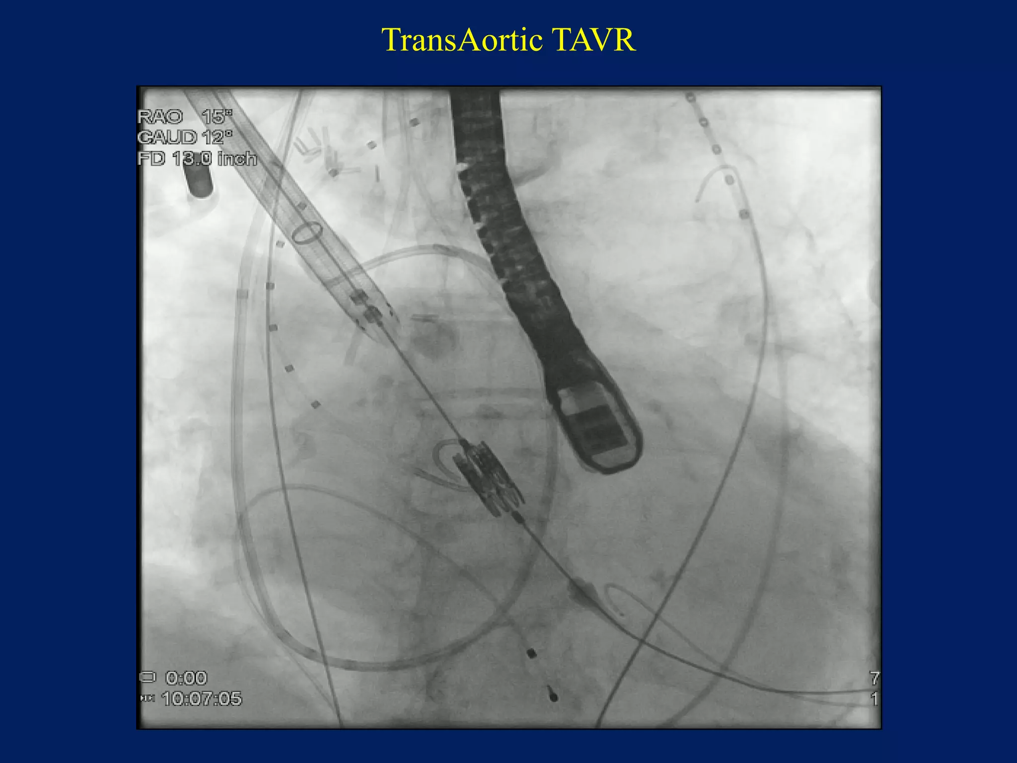 TransAortic TAVR
 