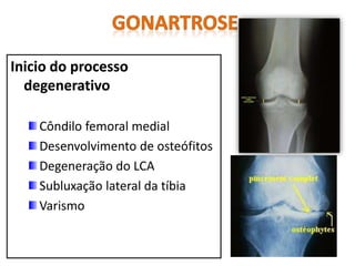 Inicio do processo
degenerativo
Côndilo femoral medial
Desenvolvimento de osteófitos
Degeneração do LCA
Subluxação lateral da tíbia
Varismo
 