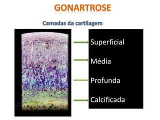 Superficial
Média
Profunda
Calcificada
 