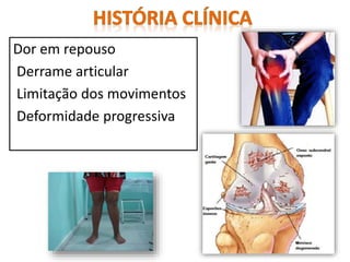 Dor em repouso
Derrame articular
Limitação dos movimentos
Deformidade progressiva
 