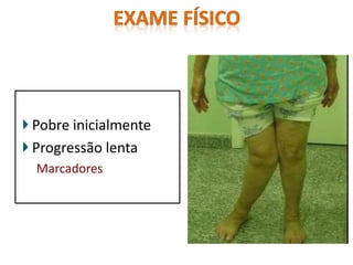 Pobre inicialmente
Progressão lenta
Marcadores
 