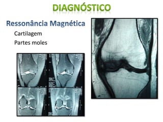 Cartilagem
Partes moles
 
