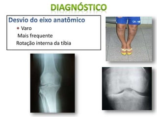 Varo
Mais frequente
Rotação interna da tíbia
 