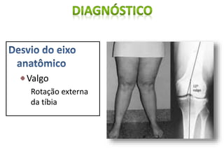 Valgo
Rotação externa
da tíbia
 