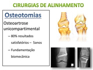 Osteoartrose
unicompartimental
– 80% resultados
satisfatórios – 5anos
– Fundamentação
biomecânica
 