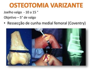 Joelho valgo - 10 a 15 °
Objetivo – 5° de valgo
• Ressecção de cunha medial femoral (Coventry)
 