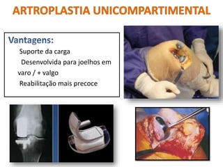 Suporte da carga
Desenvolvida para joelhos em
varo / + valgo
Reabilitação mais precoce
 