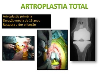 Artroplastia primária
Duração média de 15 anos
Restaura a dor e função
 