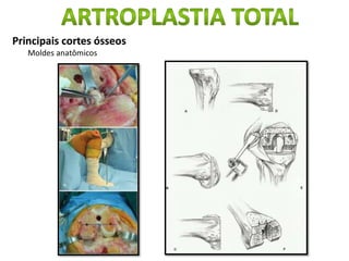 Principais cortes ósseos
Moldes anatômicos
 