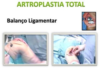 Balanço Ligamentar
 