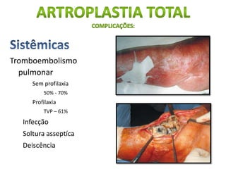 Tromboembolismo
pulmonar
Sem profilaxia
50% - 70%
Profilaxia
TVP – 61%
Infecção
Soltura asseptíca
Deiscência
 