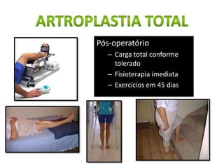 Pós-operatório
– Carga total conforme
tolerado
– Fisioterapia imediata
– Exercícios em 45 dias
 