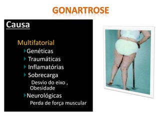 Causa
Multifatorial
Genéticas
Traumáticas
Inflamatórias
Sobrecarga
Desvio do eixo ,
Obesidade
Neurológicas
Perda de força muscular
 