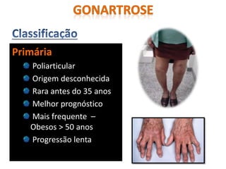 Primária
Poliarticular
Origem desconhecida
Rara antes do 35 anos
Melhor prognóstico
Mais frequente –
Obesos > 50 anos
Progressão lenta
 