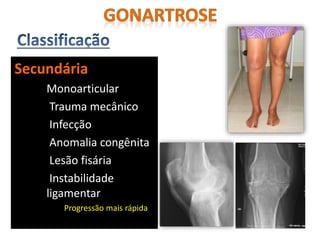 Secundária
Monoarticular
Trauma mecânico
Infecção
Anomalia congênita
Lesão fisária
Instabilidade
ligamentar
Progressão mais rápida
 