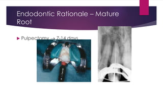 Endodontic Rationale – Mature
Root
 Pulpectomy  7-14 days
 