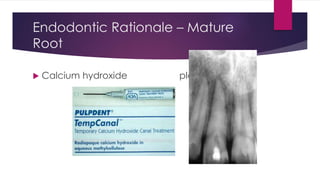 Endodontic Rationale – Mature
Root
 Calcium hydroxide placement
 