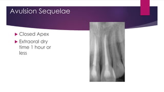 Avulsion Sequelae
 Closed Apex
 Extraoral dry
time 1 hour or
less
 