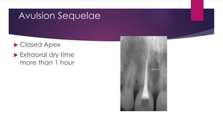 Avulsion Sequelae
 Closed Apex
 Extraoral dry time
more than 1 hour
 