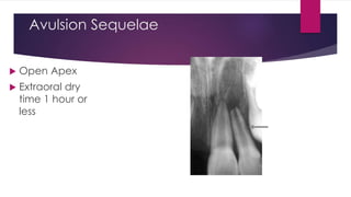 Avulsion Sequelae
 Open Apex
 Extraoral dry
time 1 hour or
less
 