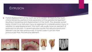 EXTRUSION
 Partial displacement of the tooth out of its socket. An injury to the tooth
characterized by partial or total separation of the periodontal ligament
resulting in loosening and displacement of the tooth. The alveolar socket
bone is intact in an extrusion injury as opposed to a lateral luxation injury. In
addition to axial displacement, the tooth will usually have an element of
protrusion or retrusion. In severe extrusion injuries the retrusion/protrusion
element can be very pronounced. In some cases it can be more
pronounced than the extrusive element.
 